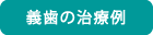 義歯の治療例