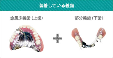 装着義歯