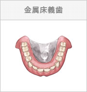 金属床義歯