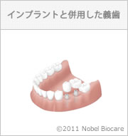 インプラントと併用した義歯