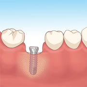 インプラント埋め込みイメージ
