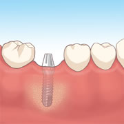 人口歯土台装着イメージ