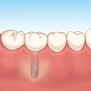人工歯の装着イメージ